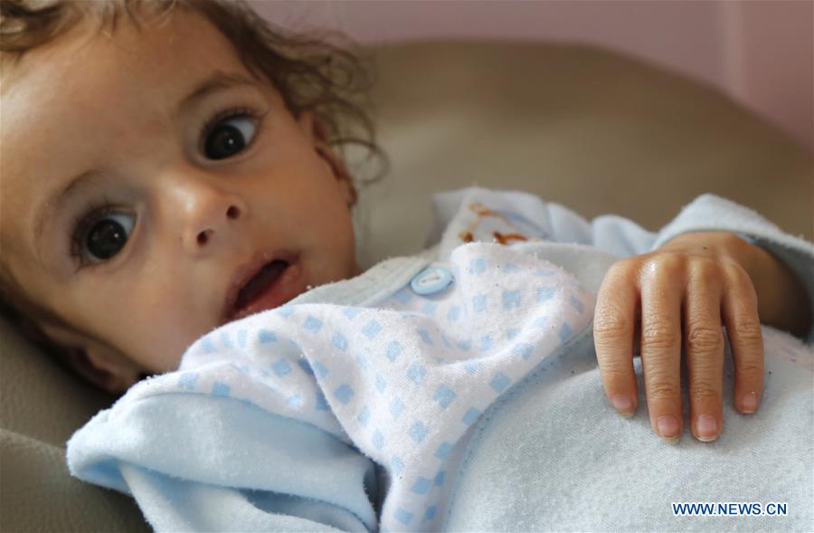 YEMEN-SANAA-FAMINE